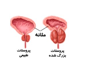 پروستاتیت چیست؟