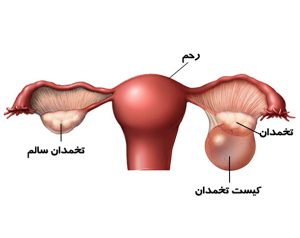 آیا کیست تخمدان با طب سنتی قابل درمان است + ۲ نسخه ساده درمانی