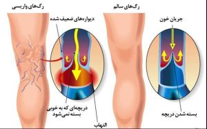 همه چیز درباره واریس پا