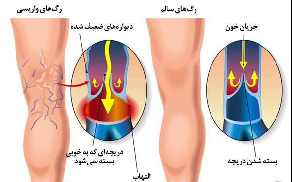 همه چیز درباره واریس پا