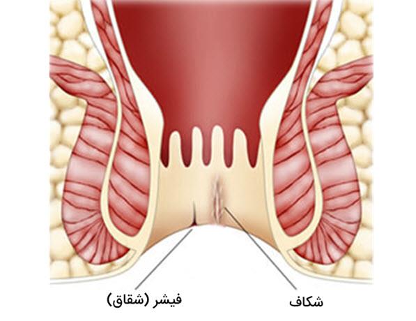 فیشر یا شقاق مقعدی و  ۱۵ درمان خانگی بسیار موثر