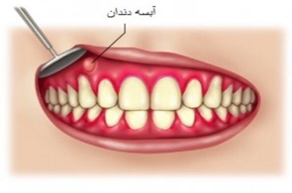 درمان خانگی عفونت و آبسه دندان