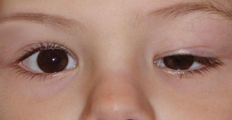 علت و درمان افتادگی پلک‌ چشم