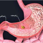 سيگار و زخم اثني عشر