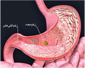 سيگار و زخم اثني عشر