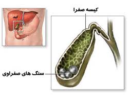 چاقی، اصلی‌ترین عامل سنگ صفرا