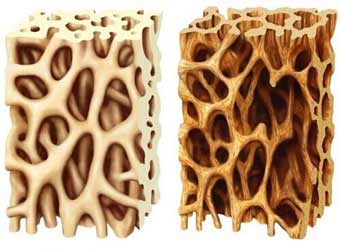 چند نکته مهم در مورد پوکي استخوان