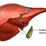 رژیم غذائی درسنگ های کیسه صفرا