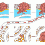 سرطان استخوان (Bone Cancer)