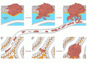 سرطان استخوان (Bone Cancer)