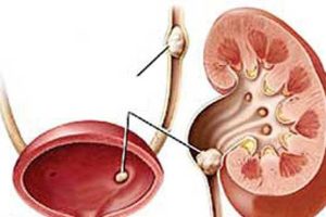 سنگ هاي دستگاه ادراري