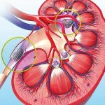 توصيه هاي غذايي در مبتلايان به سنگ کليه