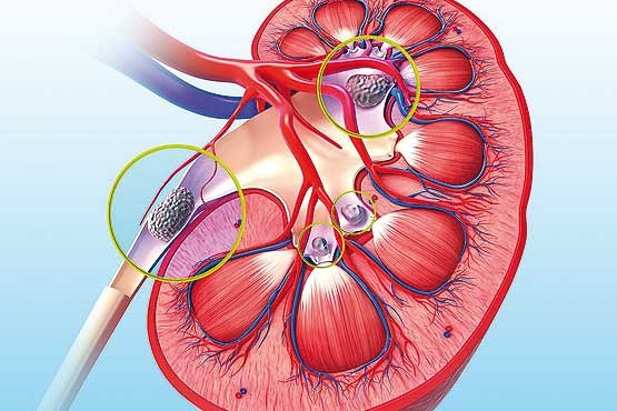 توصيه هاي غذايي در مبتلايان به سنگ کليه