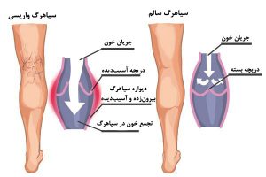 چرا به واریس پا مبتلا می شویم؟