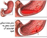 خونريزيهاي گوارشي