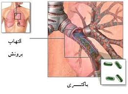 برونشيت مزمن