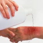 اولین کاری که بعد از سوختگی انجام می‌دهیم