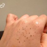 جوش ها در نقاط مختلف صورت نشان دهنده چه چیزی هستند؟